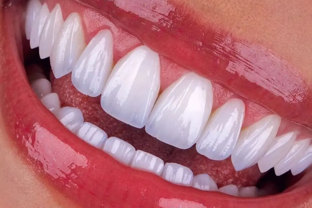 E-Max Veneer
