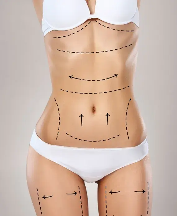 Liposuction Nedir