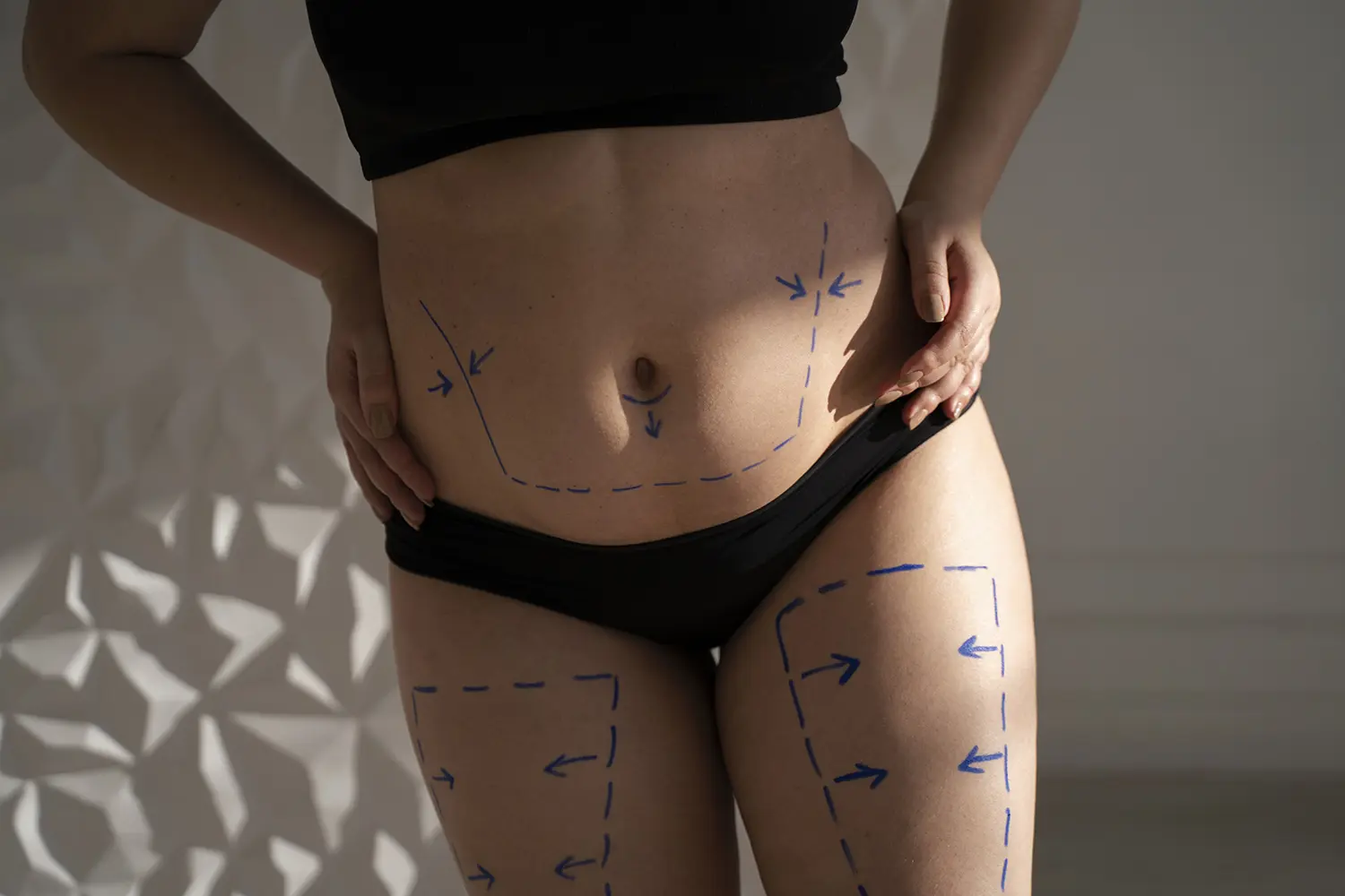 VASER Liposuction