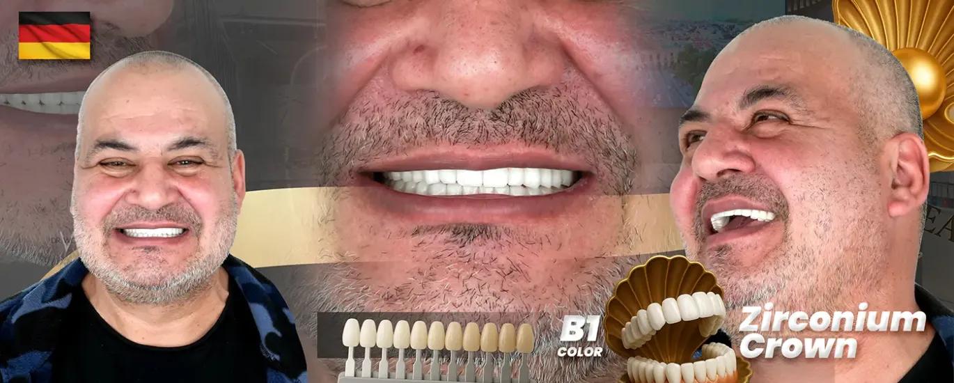 ابتسامة هوليوود