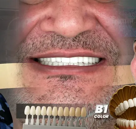 Hollywood Gülümsemesi