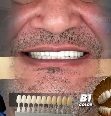 ابتسامة هوليوود