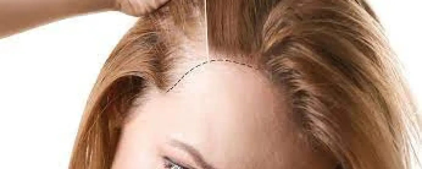 جراحة زراعة الشعر للنساء في تركيا