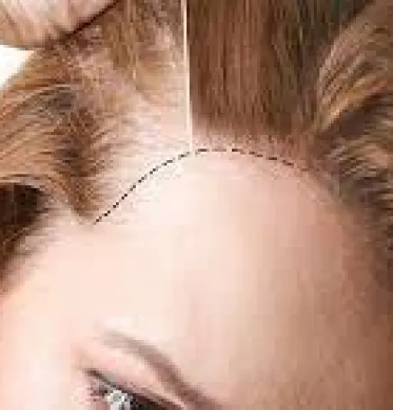 جراحة زراعة الشعر للنساء في تركيا